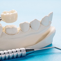 A dental crown being placed on a plaster model of a jaw