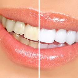 Closeup of woman’s smile that’s halved to show whitening results