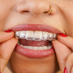 Woman putting in Invisalign trays