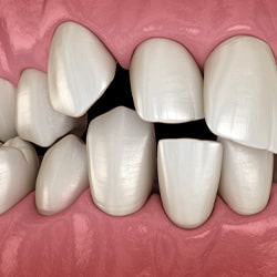 Illustration of spaced-out teeth