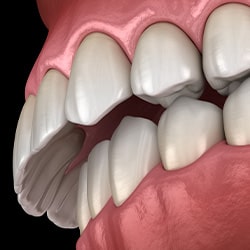 Illustration of overbite