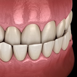 Illustration of an underbite