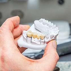 Model of dental bridge