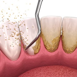 Digital illustration of scaling and root planing