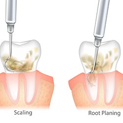 Scaling and root planing graphic